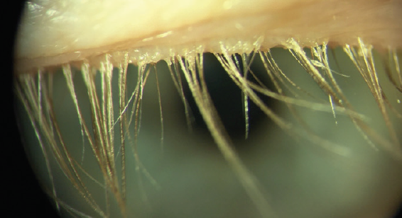 visuelle désignant l’ensemble des symptômes de fatigues oculaires. Caractérisée par un inconfort visuel et un dysfonctionnement musculaire l'asthénopie se traduit par des maux de tête, une perte de concentration, une fatigue anormale et une potentielle baisse de vue pouvant être floue. Les symptômes peuvent être temporaires ou permanents. 