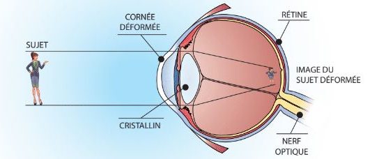 visuelle désignant l’ensemble des symptômes de fatigues oculaires. Caractérisée par un inconfort visuel et un dysfonctionnement musculaire l'asthénopie se traduit par des maux de tête, une perte de concentration, une fatigue anormale et une potentielle baisse de vue pouvant être floue. Les symptômes peuvent être temporaires ou permanents. 